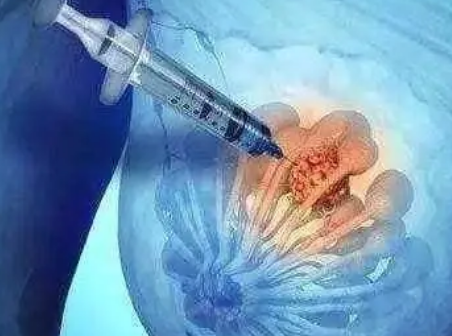 主要的全球研究揭示了乳腺癌扩散到身体其他部位的风险