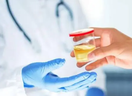 廉价的尿液检测可以发现林奇综合征患者的尿路上皮癌