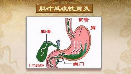 嗳气：消化道疾病的常见症状与含义