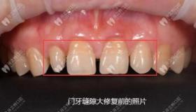 门牙有缝怎么治：解决牙齿缝隙问题的综合指南