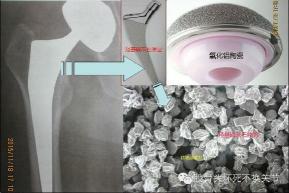 陶瓷胶水使用指南：修复陶瓷器皿的细致步骤