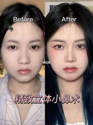 山根低，鼻梁高：如何改善低山根，提升鼻部美感